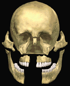 Animated illustration of facial trauma