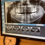 X-Ray of teeth